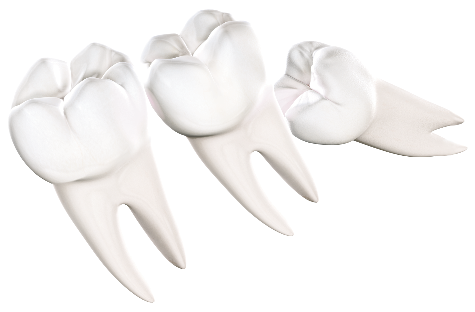 Isolated  Wisdom Teeth