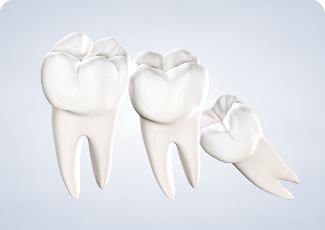 Home Wisdom Teeth Removal