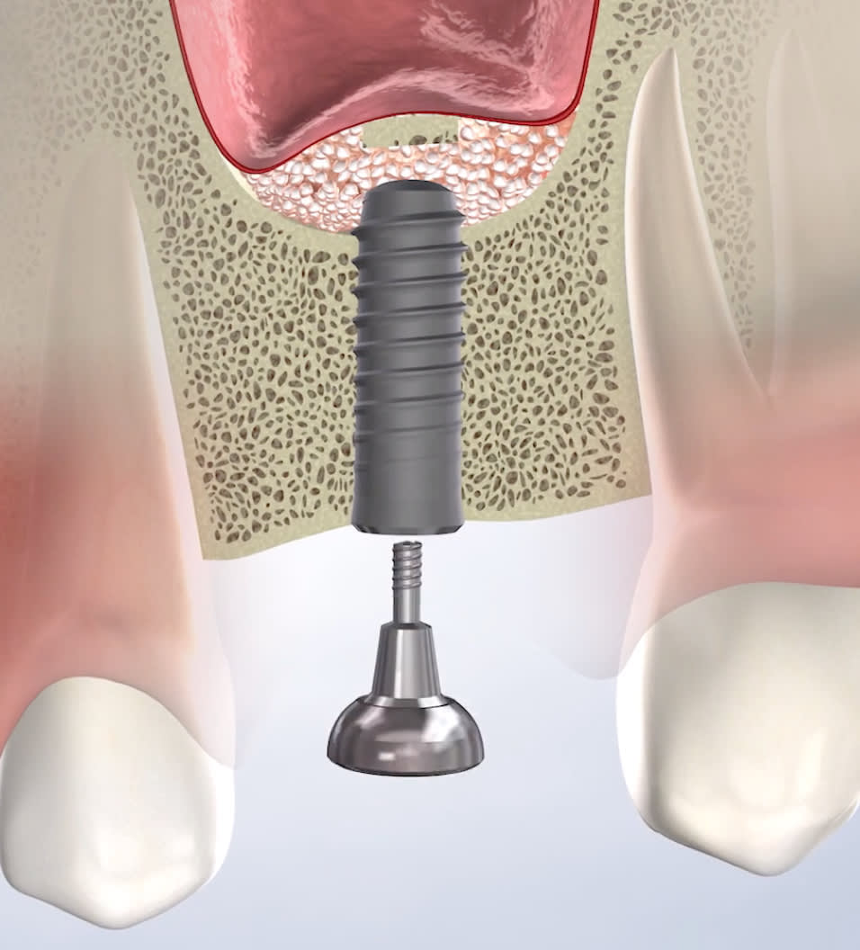 query bone grafting