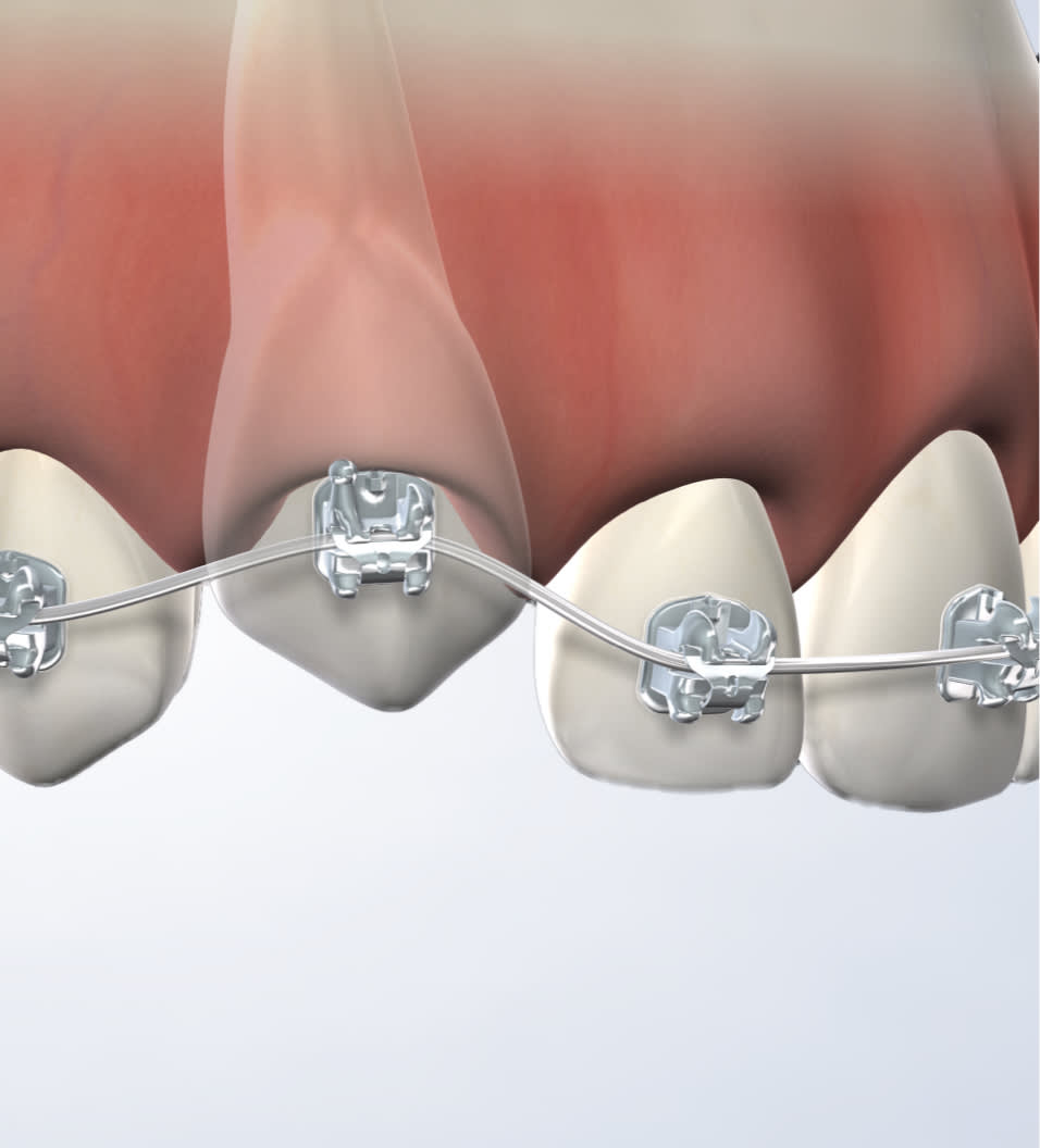 query expose and bond