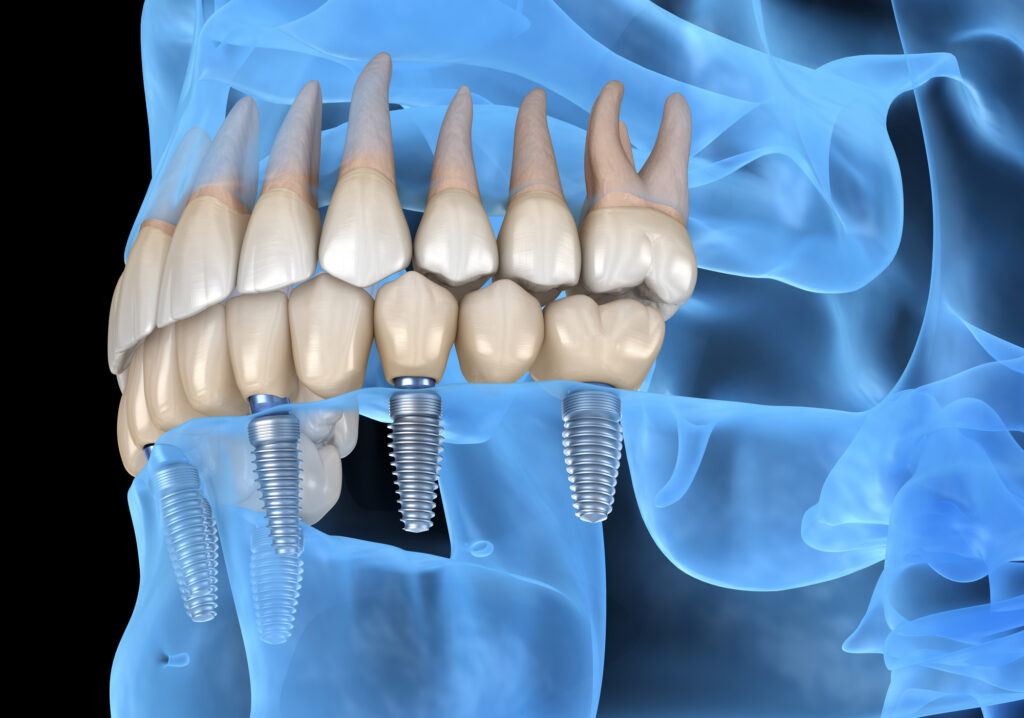 post-treatment dental implant care