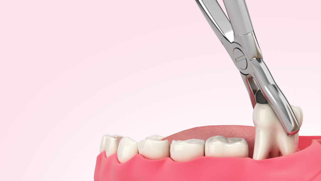tooth extraction st george