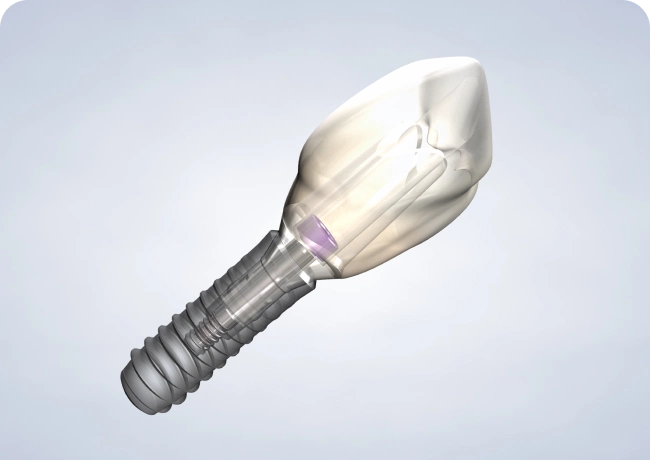 Dental Implants St George