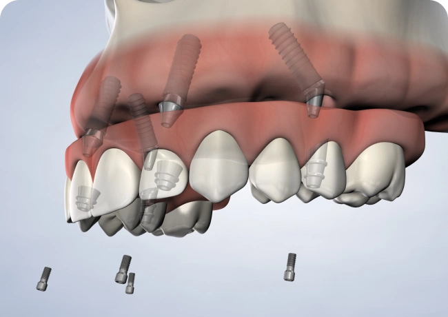 Full Arch Restoration