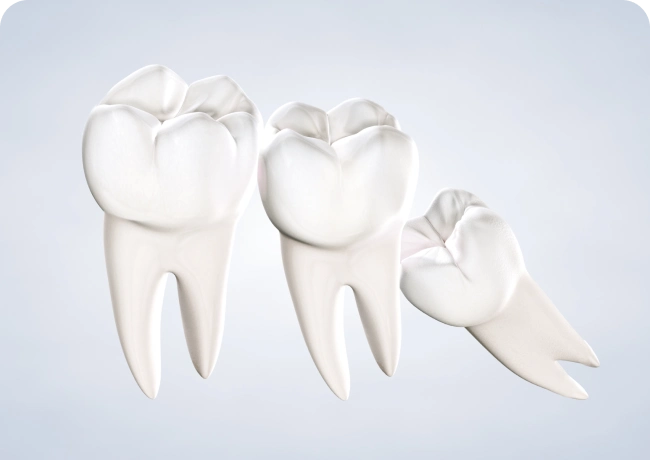 Wisdom Teeth Removal