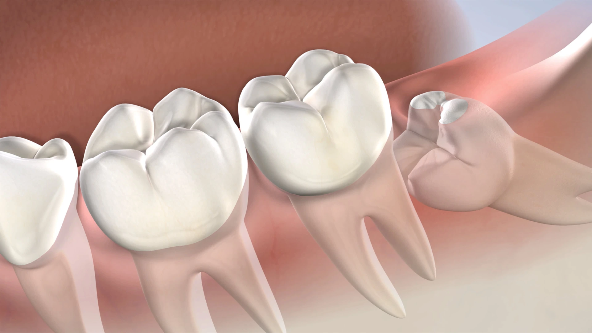 Wisdom teeth removal instructions