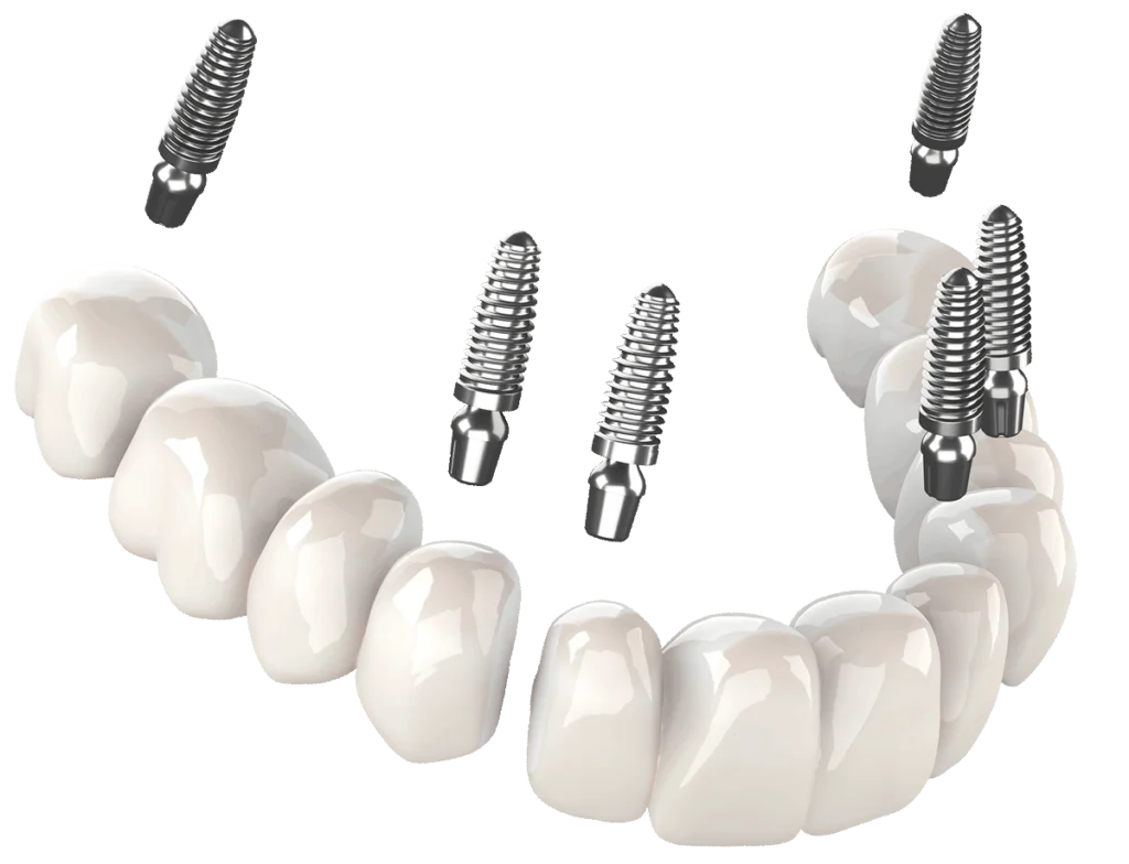 3 on 6 dental implants