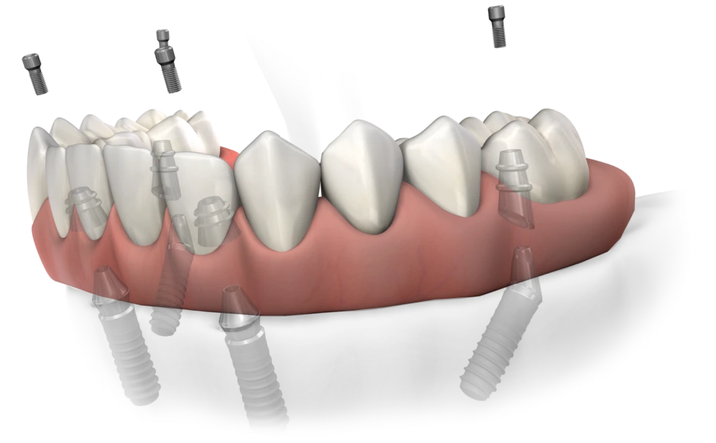 All on 4 dental implants