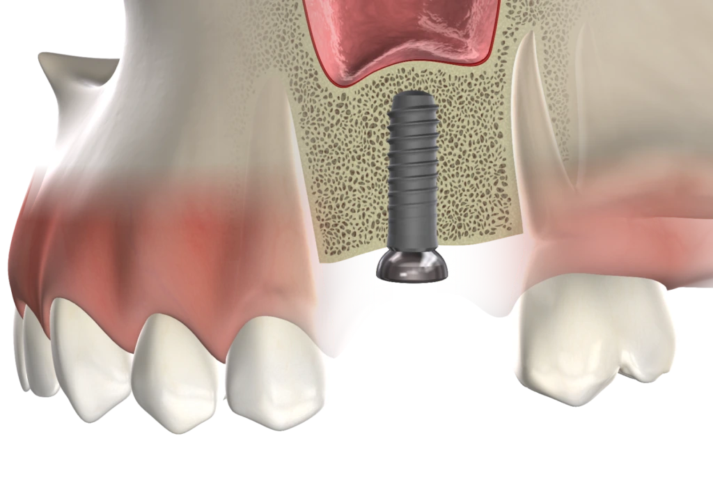 Bone grafting