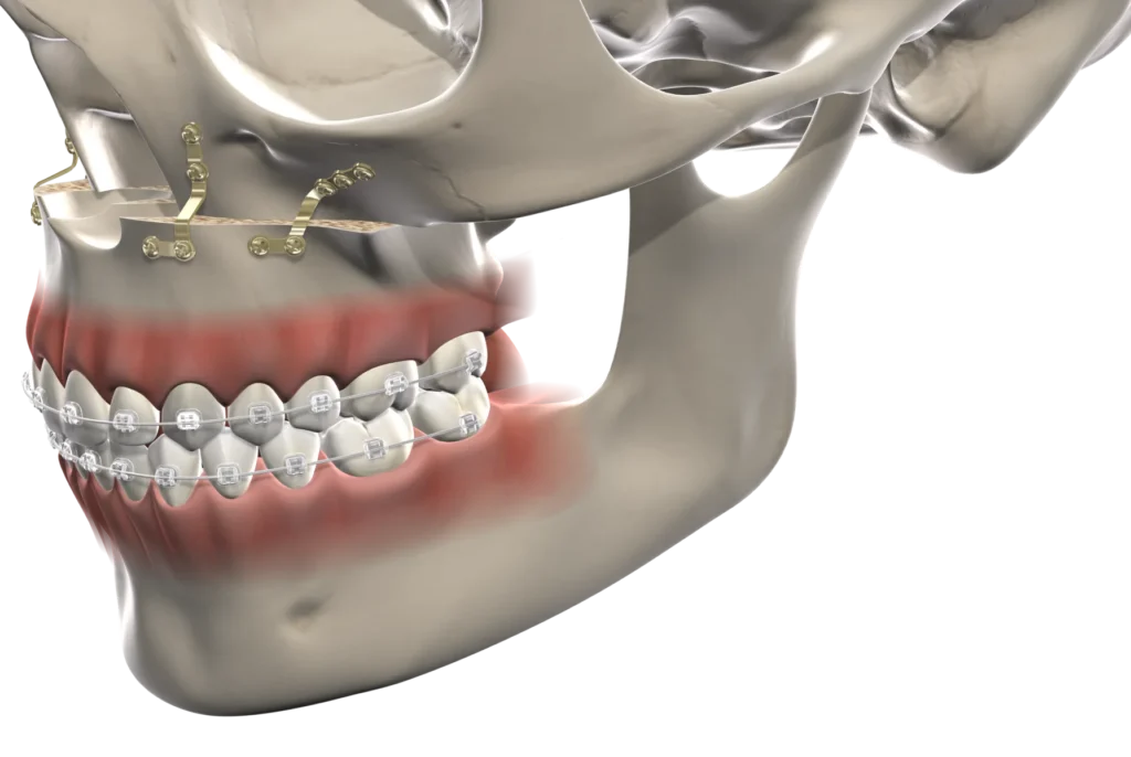 Facial Trauma