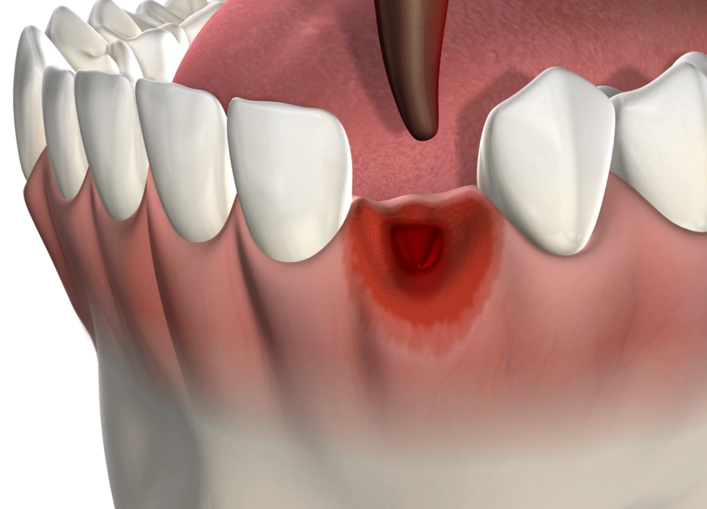 Tooth Extractions