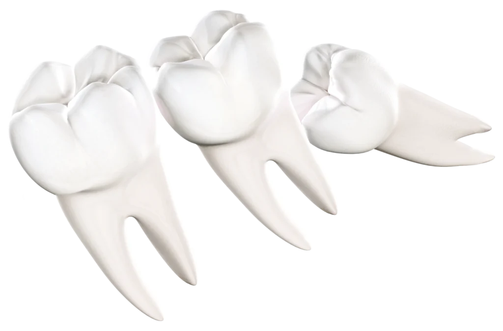 Wisdom Teeth removal St George UT