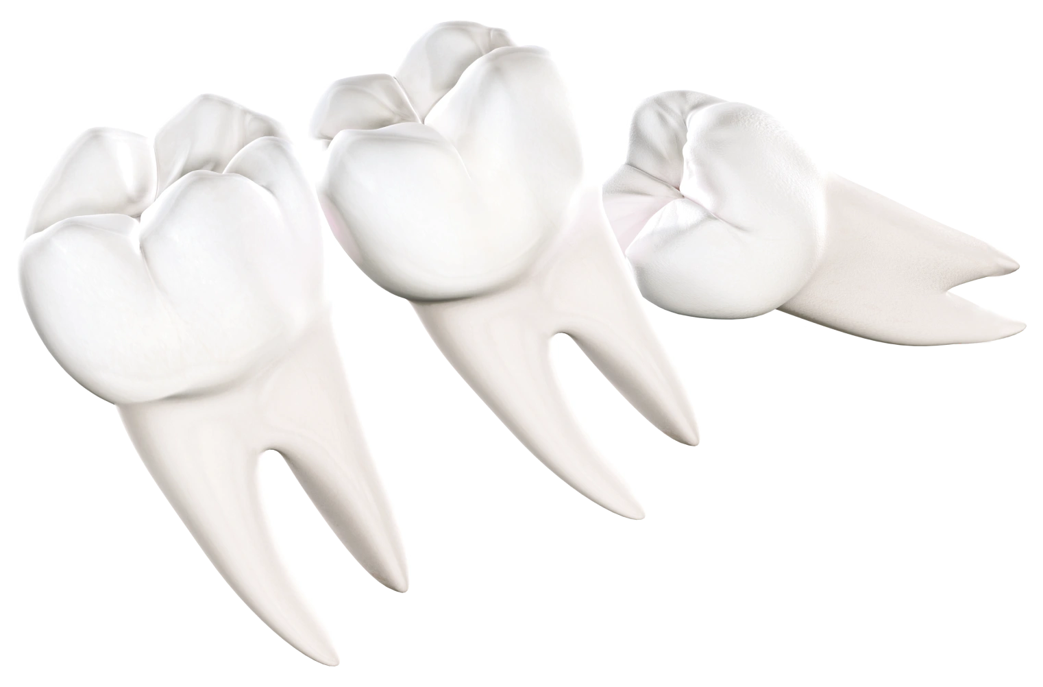 Wisdom Teeth removal St George UT