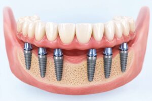 3 on 6 dental implants