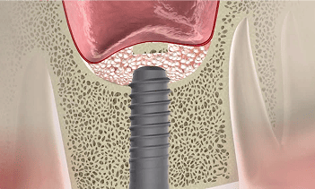 implant procedure
